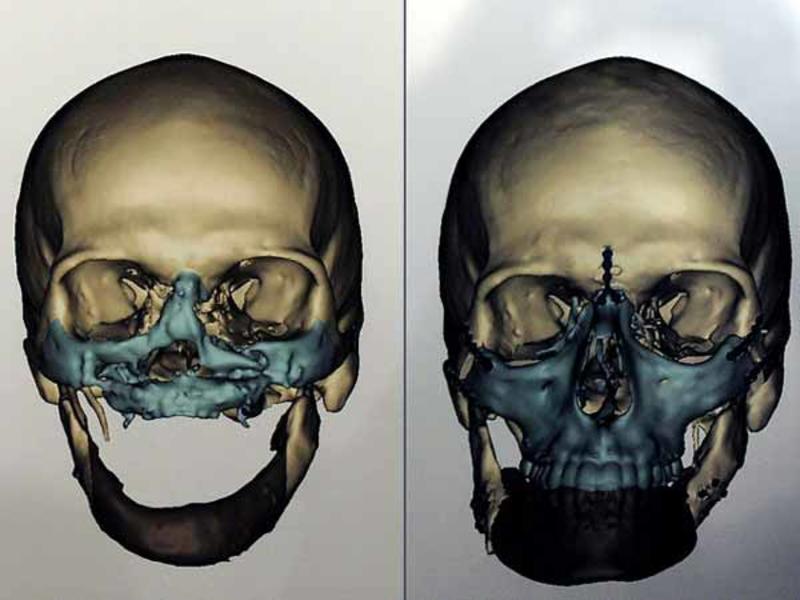 Медики сделали самую масштабную пересадку лица