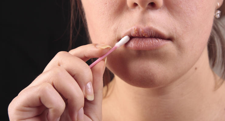 Интересный факт дня: язвочки на губах приводят к слабоумию