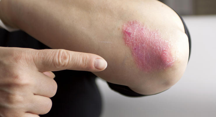 Составлен список самых опасных заболеваний кожи