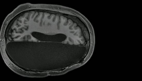 Тайна людей с половиной мозга раскрыта