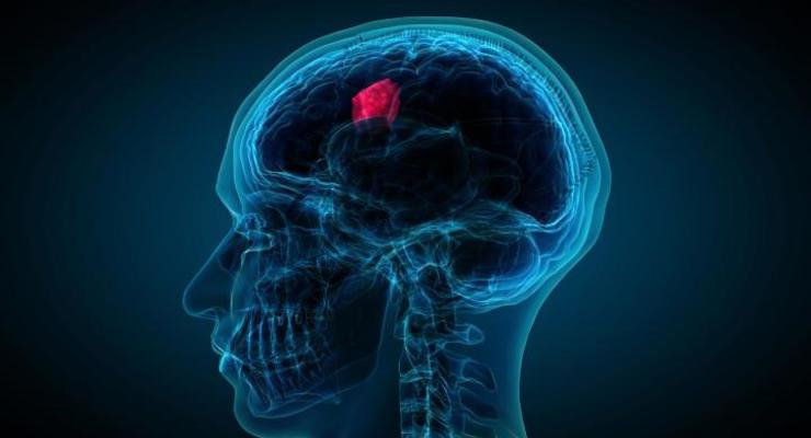 Искусственный интеллект научился определять рак мозга лучше человека