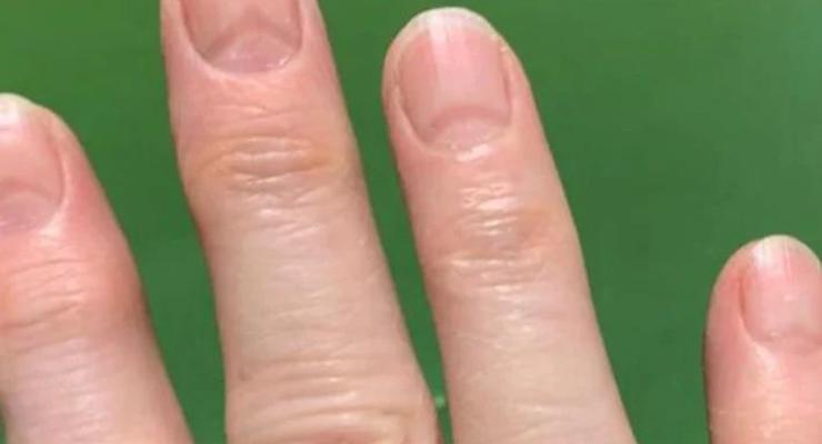 Обнаружено странное влияние коронавируса на ногти