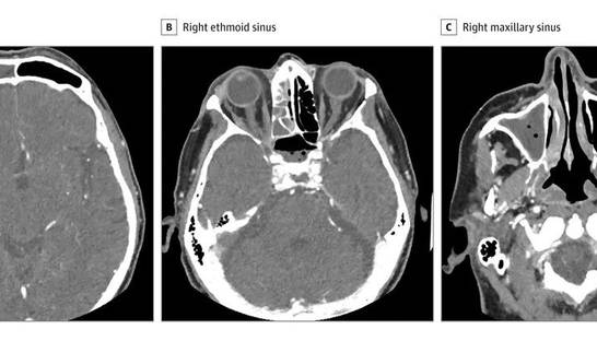 Новый симптом: Больной COVID-19 временно потерял зрение