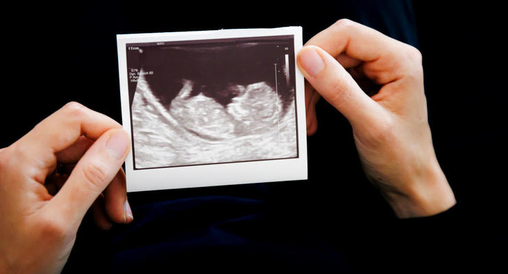 Шанс на миллион: женщина с двумя матками забеременела в обеих сразу