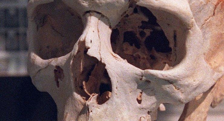 Залізний лом пройшов крізь череп: учені відтворили обличчя чоловіка після страшної травми